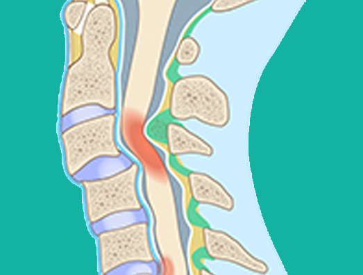 Mielopatia cervical