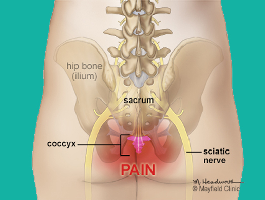 Dor no cóccix (coccidinia)