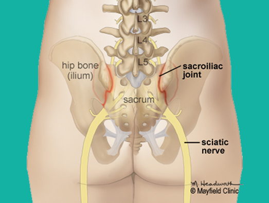 Dor/fusão nas articulações sacroilíacas