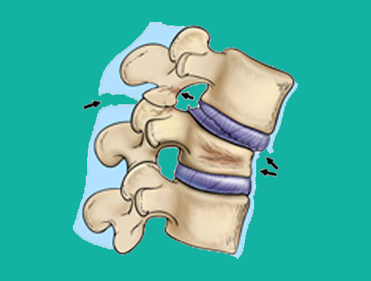 Fraturas da coluna vertebral