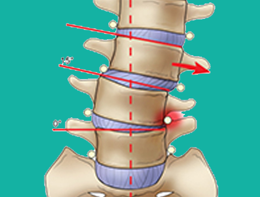 Deformidade da coluna vertebral, escoliose